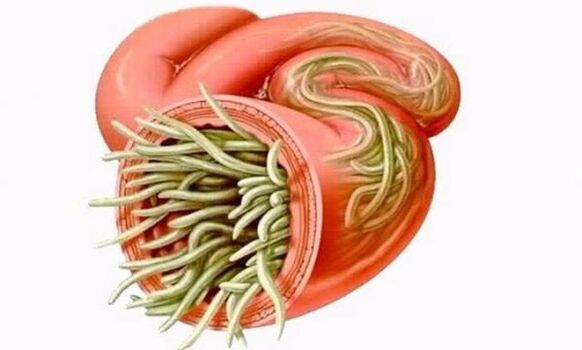 červy v ľudskom čreve